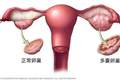 终于改名！这个病困扰全球1.7亿女性，却被“叫错”90年