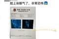 男子健身后脸上染“脚气”，多人曾中招：坐了一会儿，屁股就长了一片痘痘