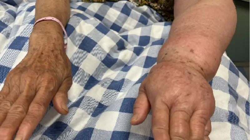 这种蚊媒传染病可致淋巴水肿,我国已消除,出国旅行仍需警惕