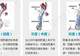 备孕两年无果,28岁杭州男子傻眼:这里竟藏了一窝“蚯蚓”!医生:千万别小看了