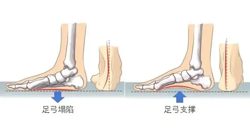 6种可能很伤脚的“网红鞋”，很多人天天穿